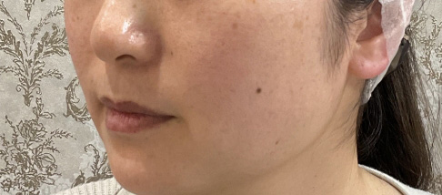 フェアリースキン使用者の症例写真 使用後一人目横顔