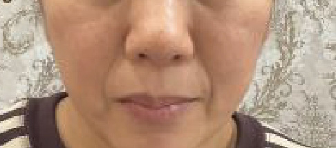 フェアリースキン使用者の症例写真 使用前一人目