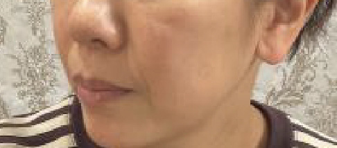 フェアリースキン使用者の症例写真 使用前一人目横顔