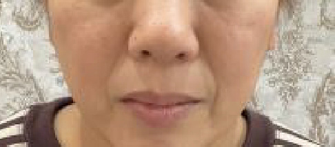 フェアリースキン使用者の症例写真 使用後一人目正面