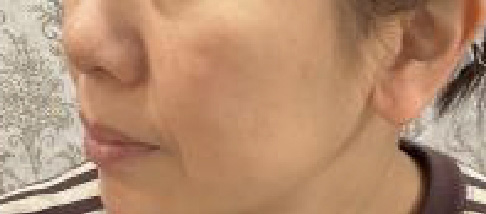 フェアリースキン使用者の症例写真 使用後一人目横顔