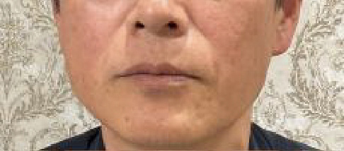 フェアリースキン使用者の症例写真 使用前一人目