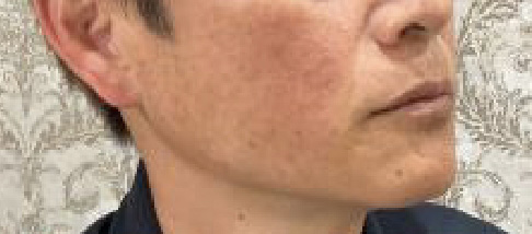 フェアリースキン使用者の症例写真 使用前一人目横顔