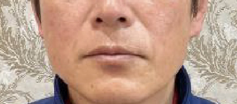 フェアリースキン使用者の症例写真 使用後一人目正面