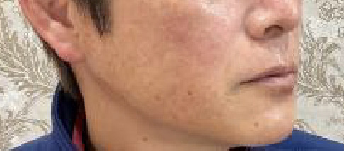 フェアリースキン使用者の症例写真 使用後一人目横顔
