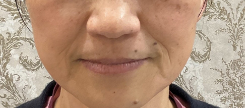 フェアリースキン使用者の症例写真 使用前一人目