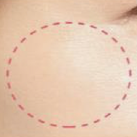 症例写真 使用後