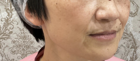 フェアリースキン使用者の症例写真 使用前一人目横顔