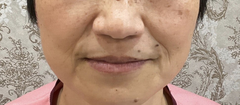 フェアリースキン使用者の症例写真 使用後一人目正面