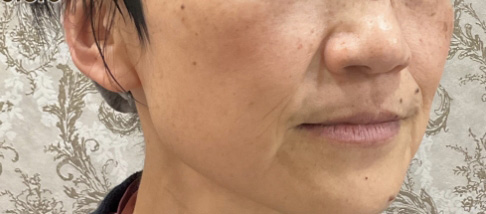 フェアリースキン使用者の症例写真 使用後一人目横顔