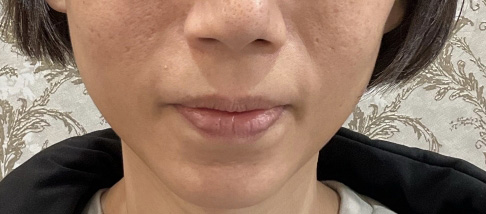 フェアリースキン使用者の症例写真 使用前一人目