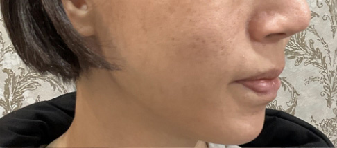 フェアリースキン使用者の症例写真 使用前一人目横顔