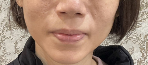 フェアリースキン使用者の症例写真 使用後一人目正面