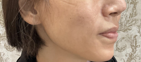 フェアリースキン使用者の症例写真 使用後一人目横顔