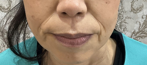 フェアリースキン使用者の症例写真 使用前一人目