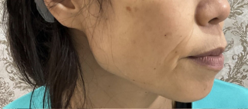 フェアリースキン使用者の症例写真 使用前一人目横顔