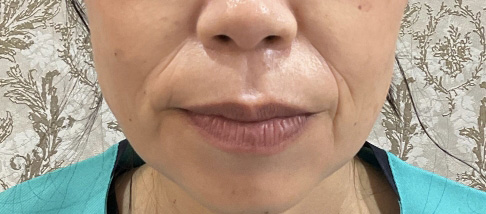 フェアリースキン使用者の症例写真 使用後一人目正面