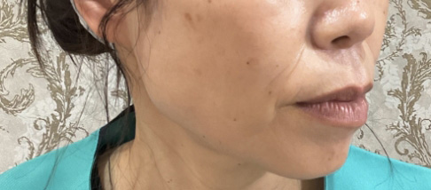 フェアリースキン使用者の症例写真 使用後一人目横顔