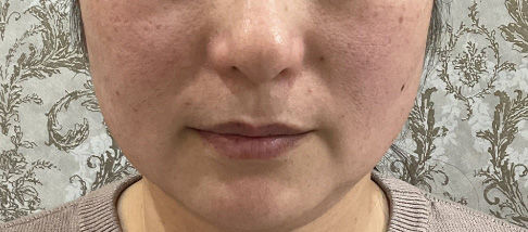 フェアリースキン使用者の症例写真 使用前一人目正面