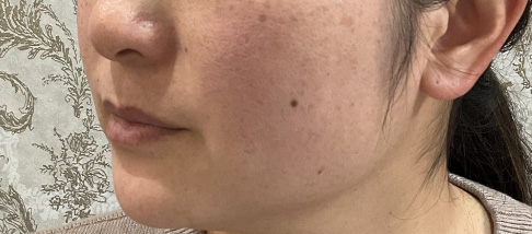 フェアリースキン使用者の症例写真 使用前一人目横顔