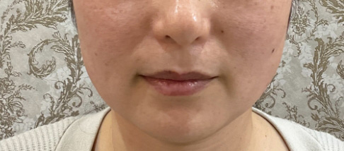 フェアリースキン使用者の症例写真 使用後一人目正面